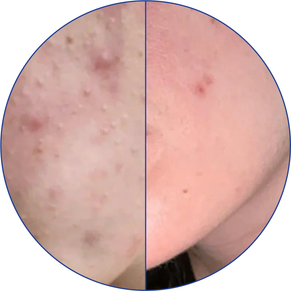Side-by-side comparison of skin with and without blemishes in a circular frame.