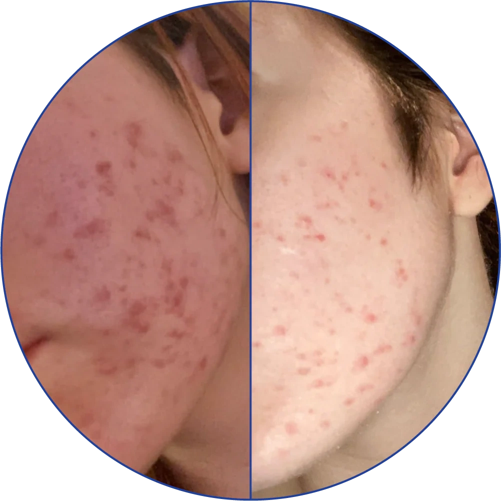 Close-up of a face with acne marks before and after treatment.