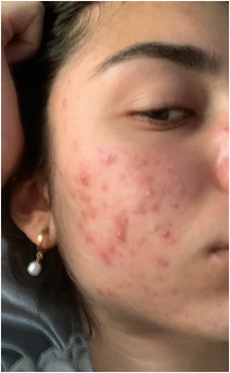 Skin Care Before