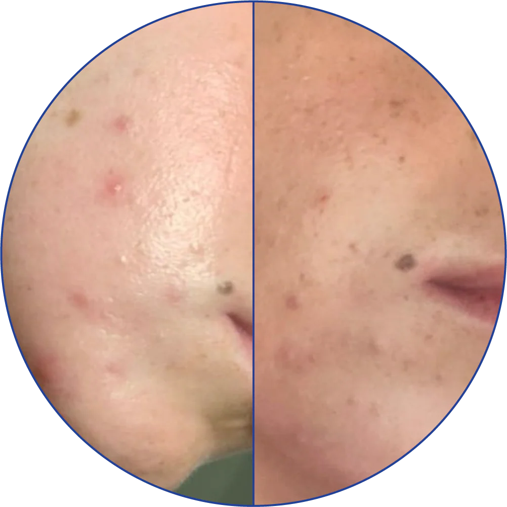 Close-up of a face showing skin blemishes and improvement.