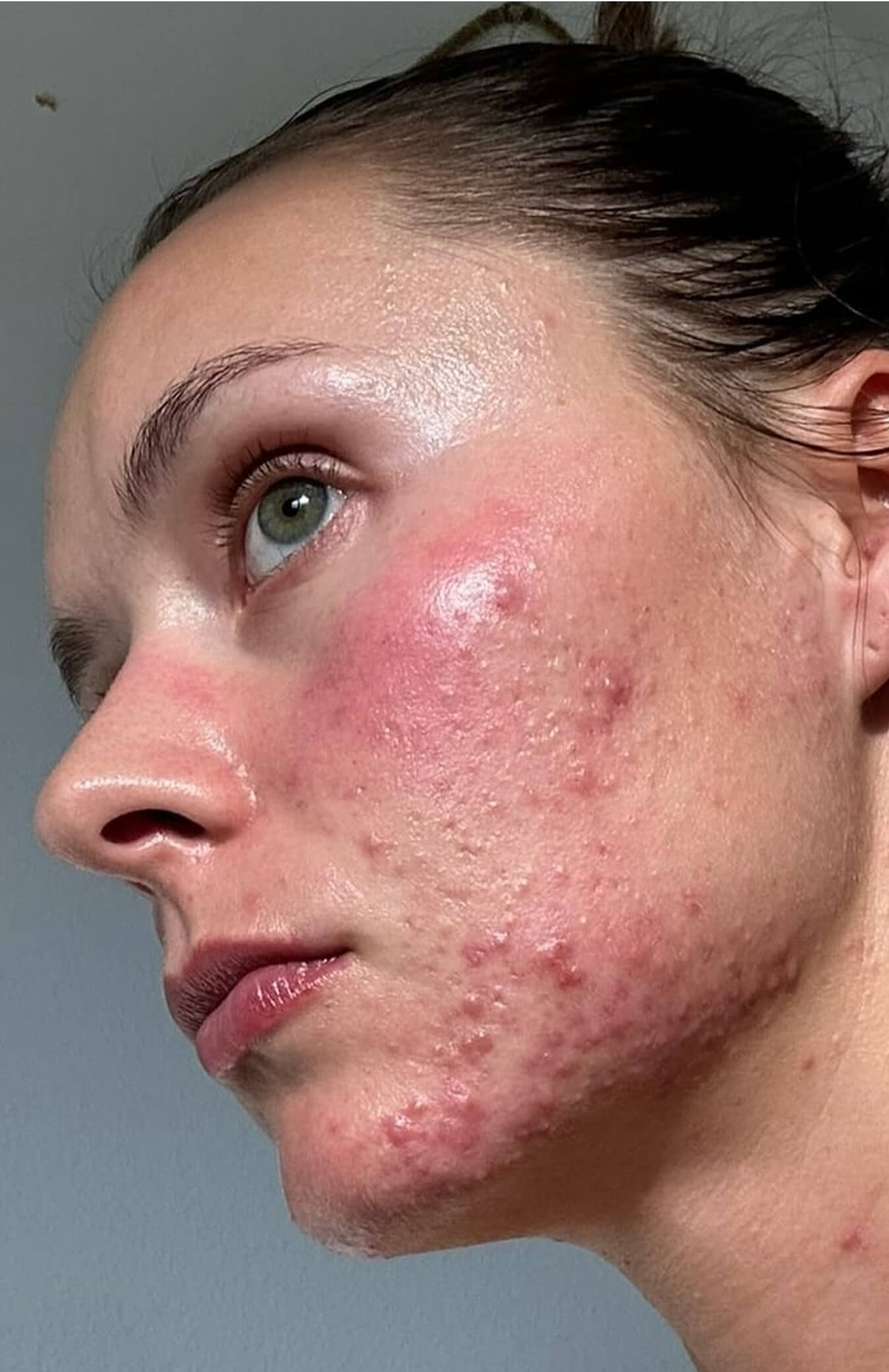 Close-up of a person's face with acne and redness on the cheek.