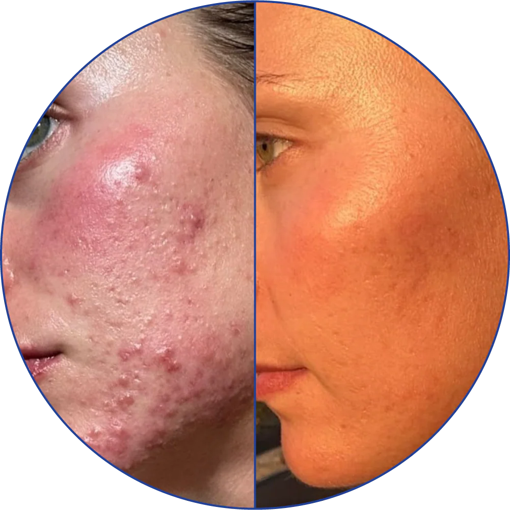 Split image showing a face with acne before and clearer skin after treatment.