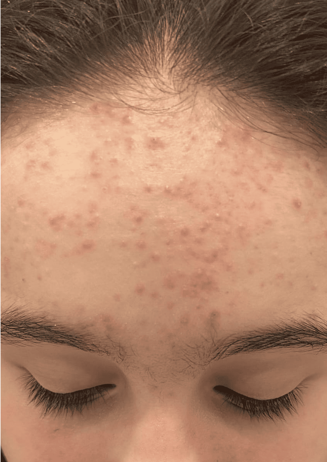 Skin Care Before