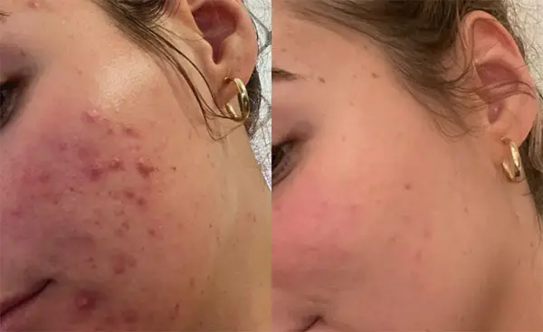 Side-by-side comparison of a face with acne before and after treatment.