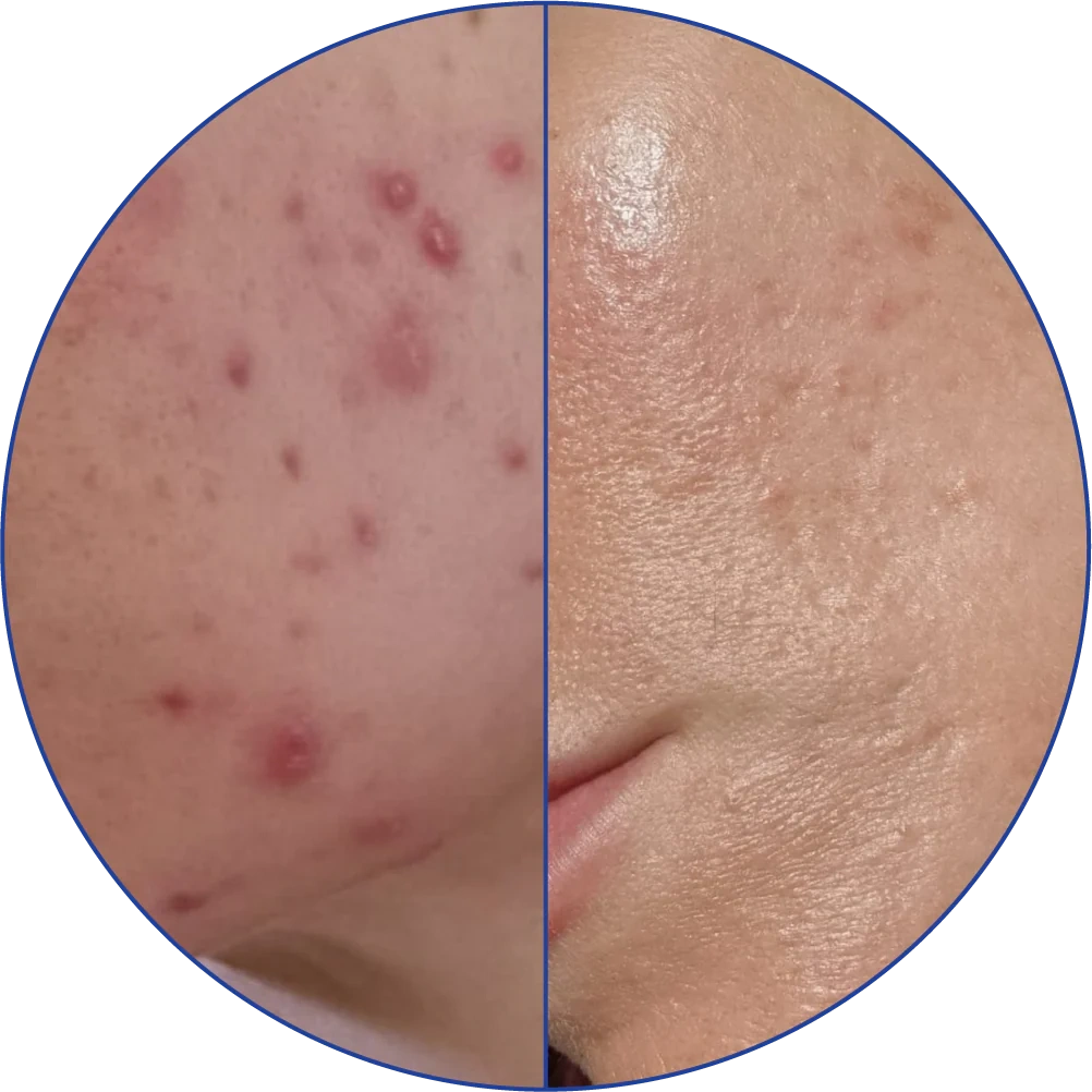 Side-by-side comparison of acne-prone skin and clearer skin.
