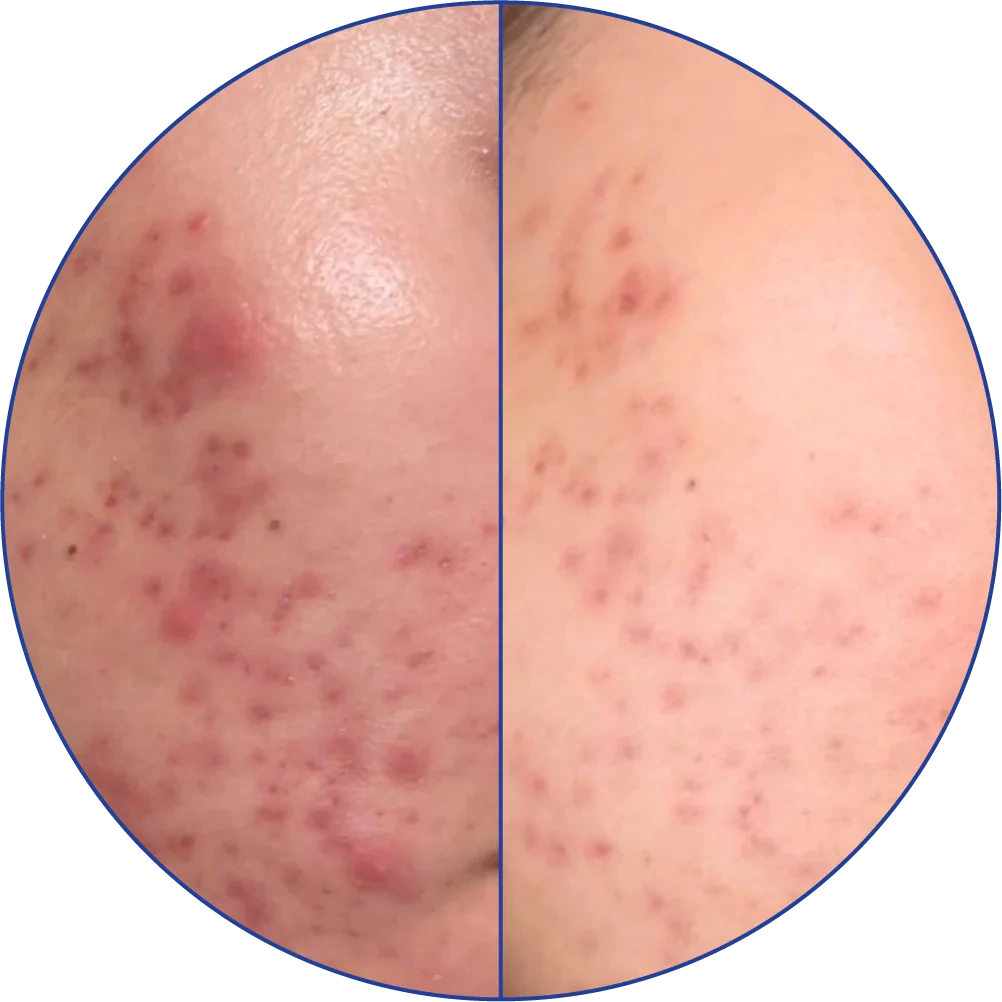 Close-up comparison of facial skin with acne before and after treatment.