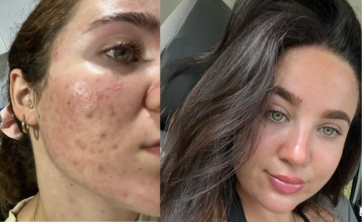 Split image showing close-up of a woman's face with skin conditions and clear skin.