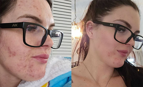 Side-by-side comparison of a woman's face with and without acne.
