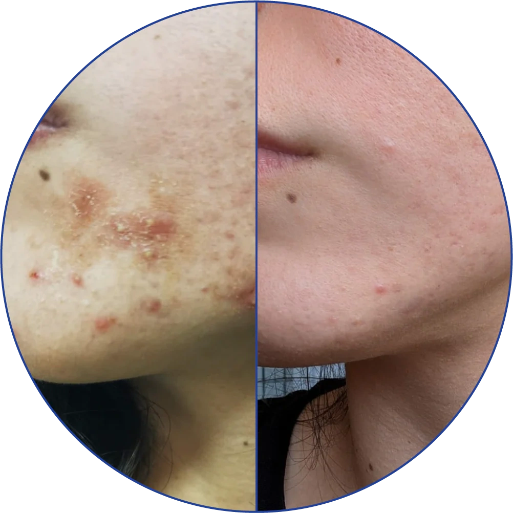 Side-by-side comparison of acne-affected and clearer skin on a face.