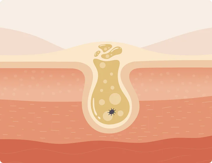 Illustration of a cross-section of a clogged skin pore with bacteria.