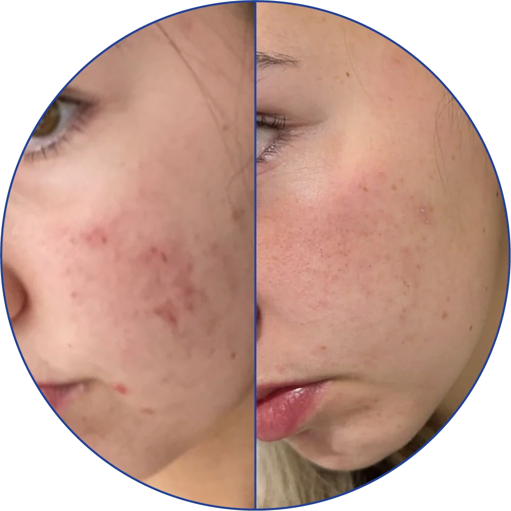 Side-by-side comparison of skin with acne and clearer skin.