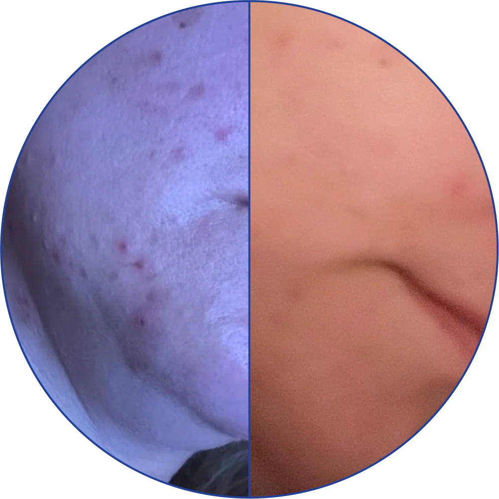 Split image showing a close-up of skin texture with acne on the left, smoother skin on the right.
