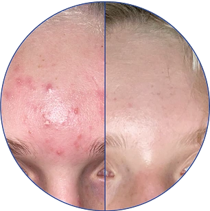 Split image showing forehead before and after acne treatment.