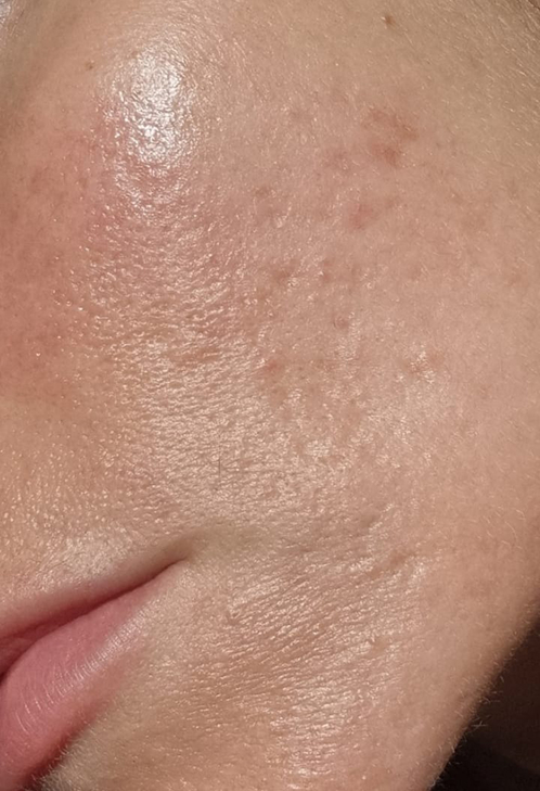 Close-up of a person's skin with visible texture and pores.