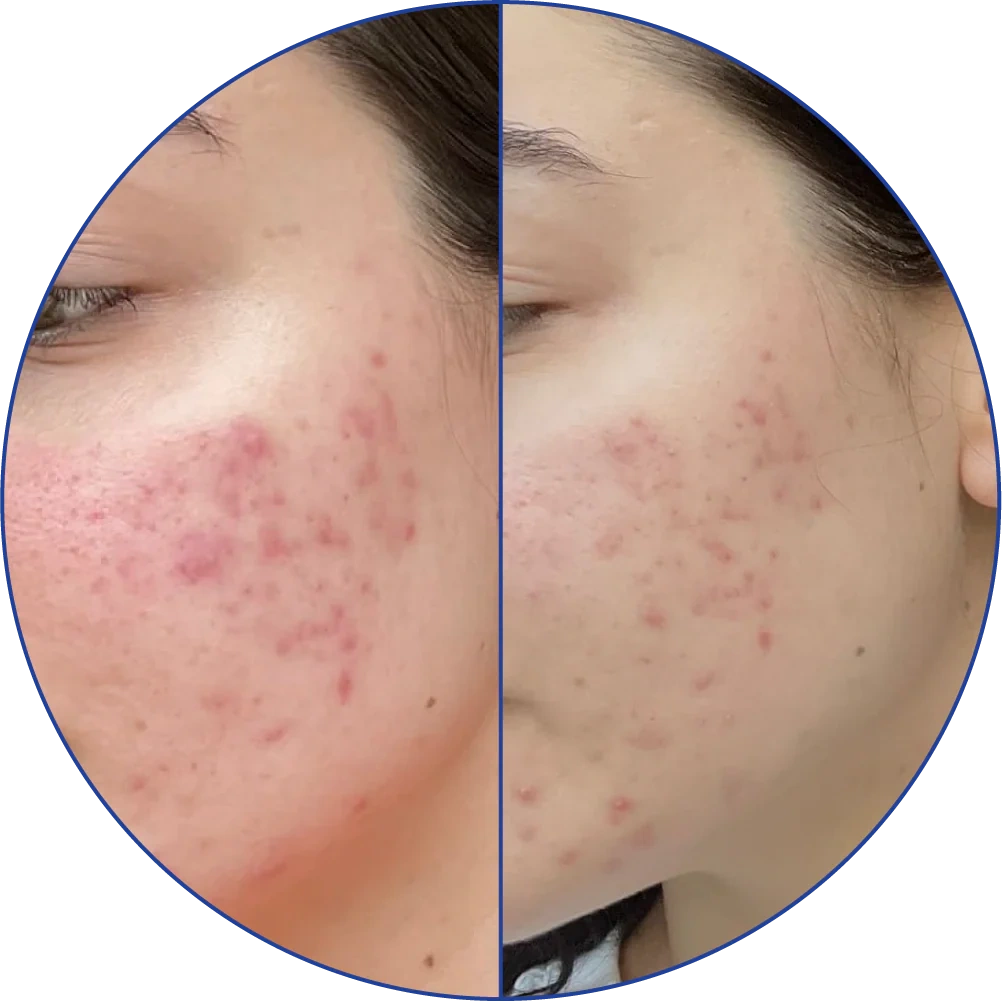 Side-by-side comparison of facial skin before and after treatment, showing reduced redness.