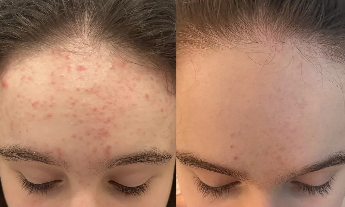 Side-by-side close-up of a forehead with acne and clear skin.