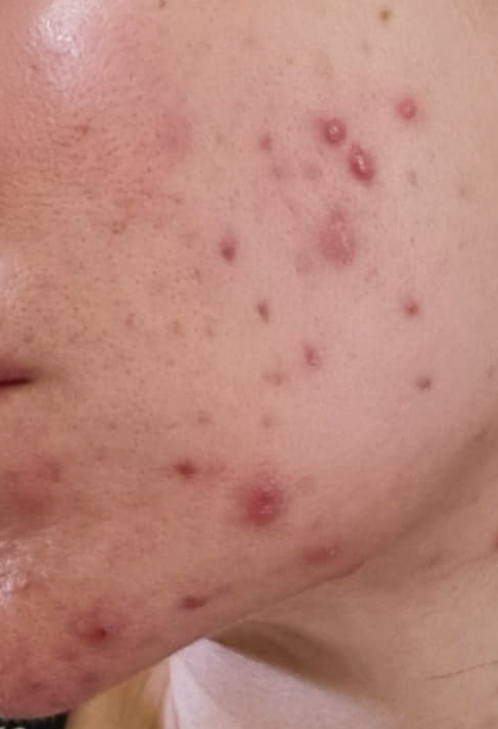 Close-up of a person's cheek with acne and blemishes.