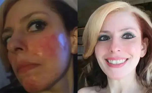 Side-by-side comparison of a woman's face showing redness and then clear skin.