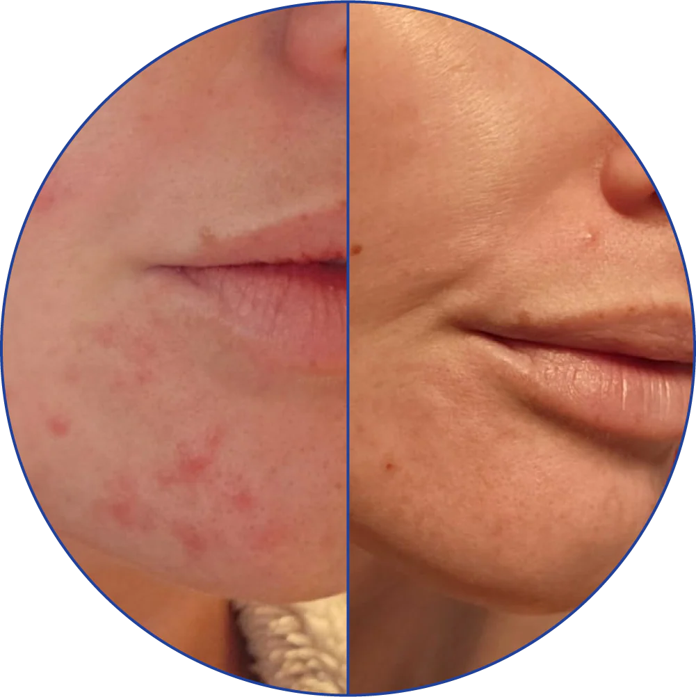 Side-by-side comparison of a chin with acne and clearer skin.