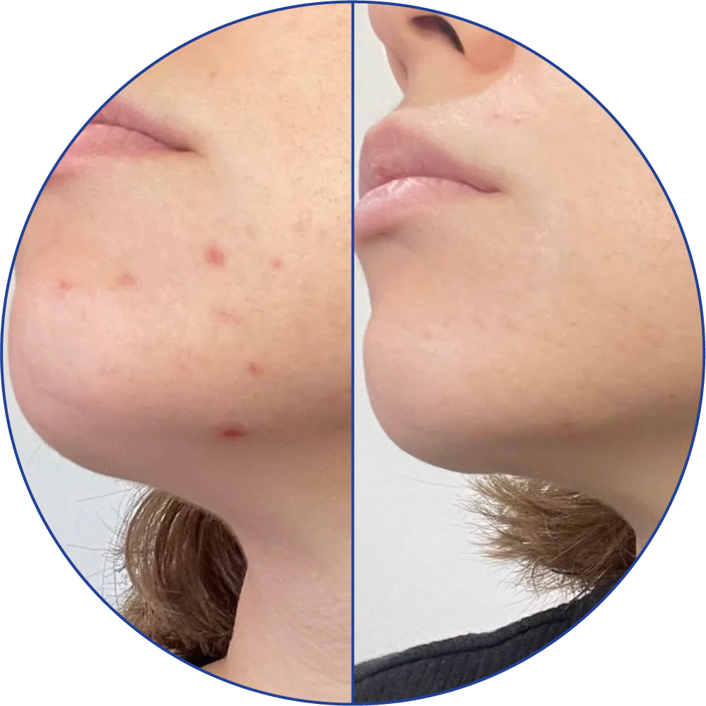 Side-by-side comparison of a chin before and after treatment, showing acne improvement.