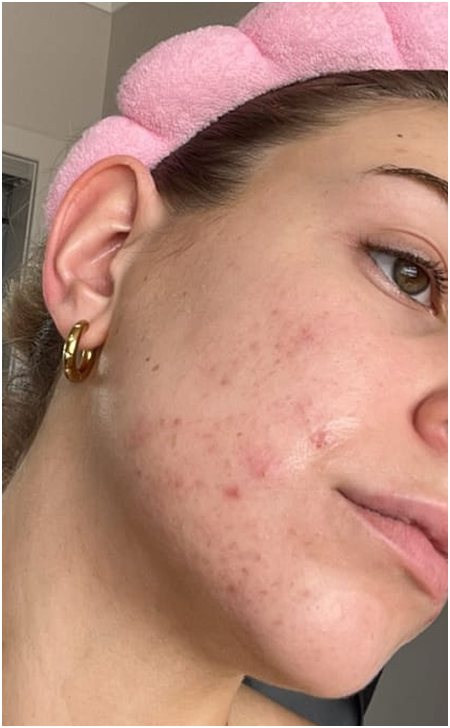 Skin Care Before