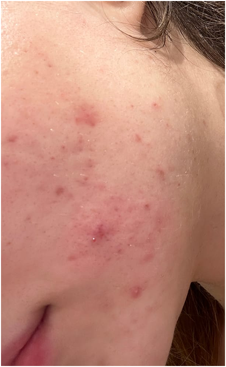 Skin Care Before