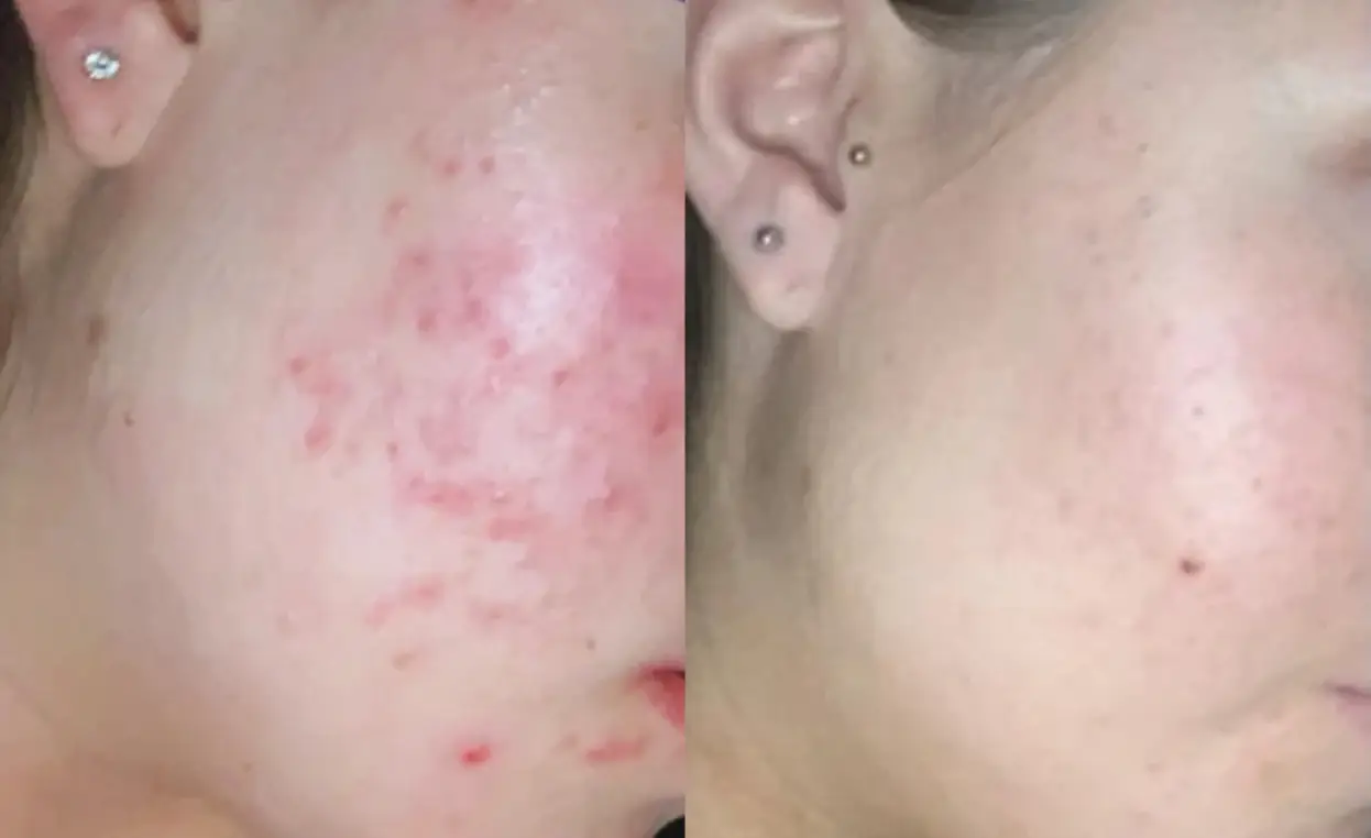 Side-by-side comparison of acne treatment on a person's cheek.