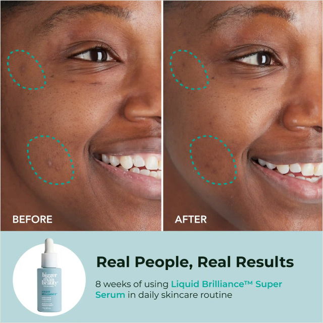 Before and after close-up comparison highlighting improved skin texture