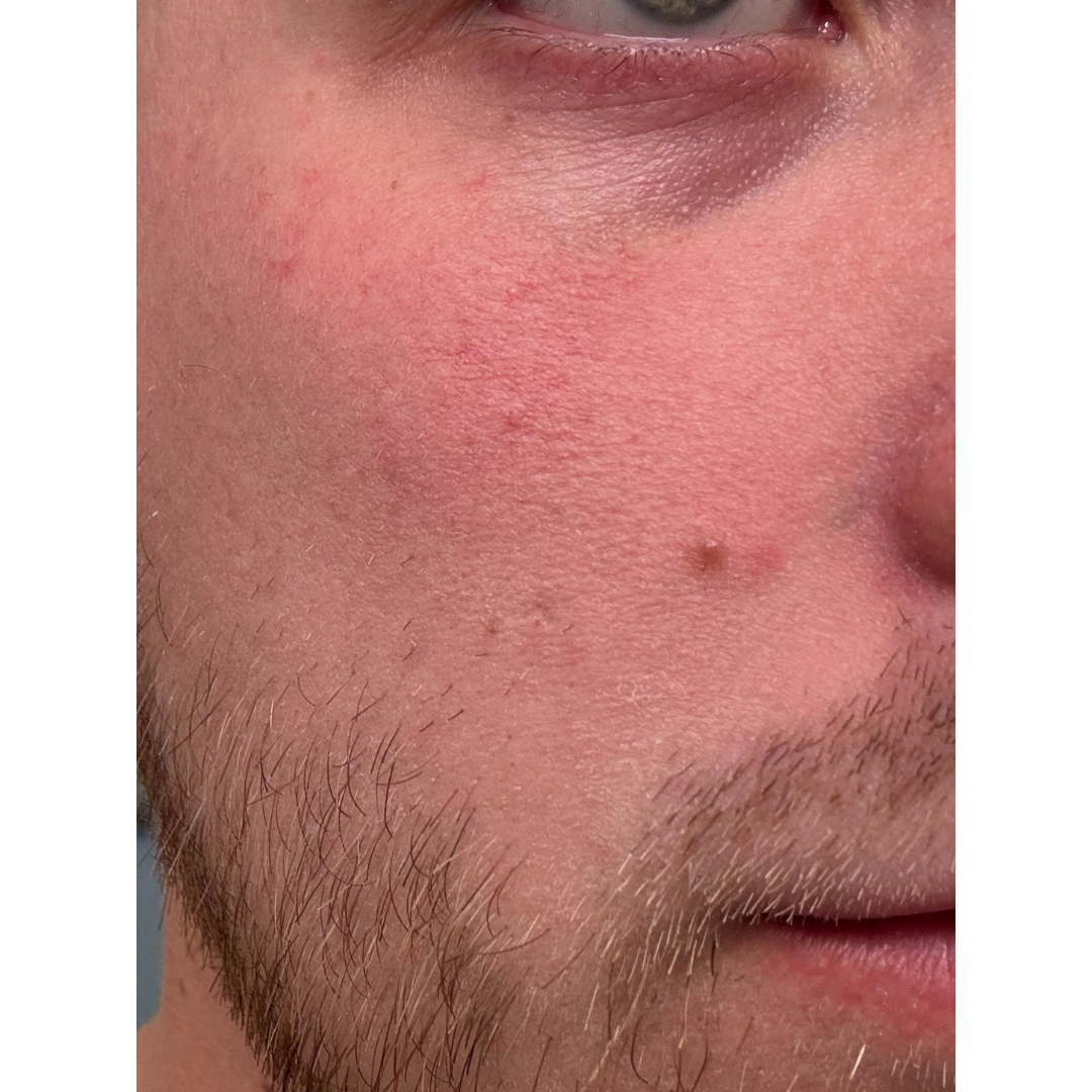 Close-up of the lower half of a person's face with facial hair and reddish skin.