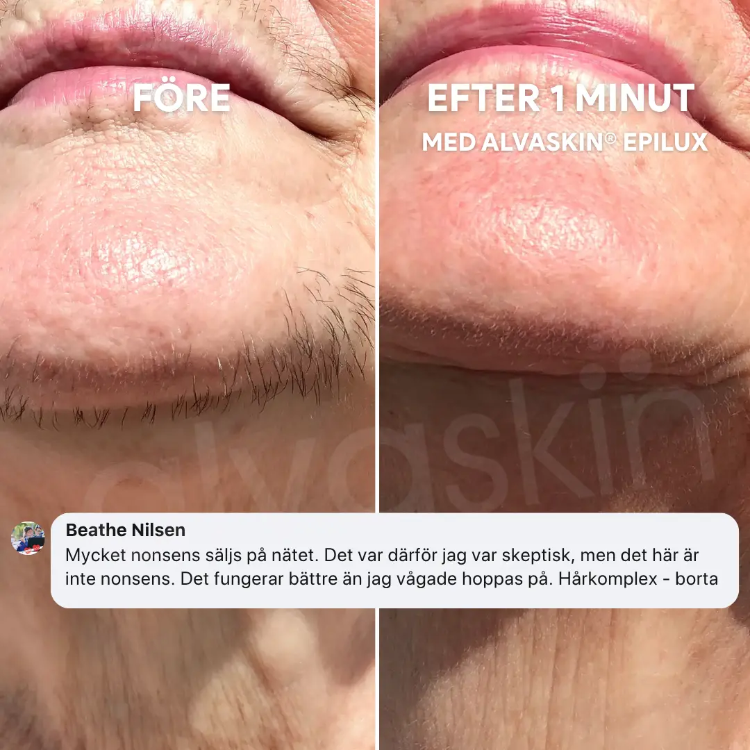 A before and after comparison showing the removal of dark facial hair from a person's chin.