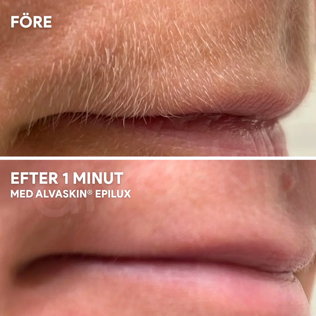 A before-and-after image showing the removal of fine hair from an upper lip area.