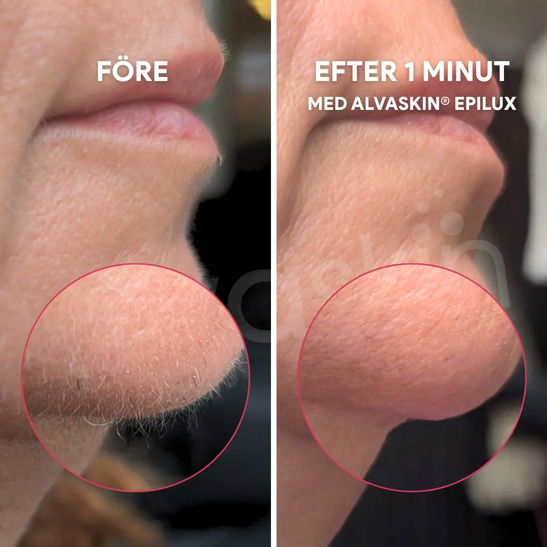 A before and after comparison showing the removal of hair from a person's chin with a beauty product.