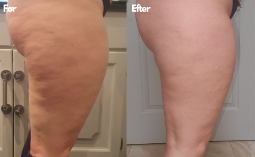 Before and after images of a leg with visible skin changes.