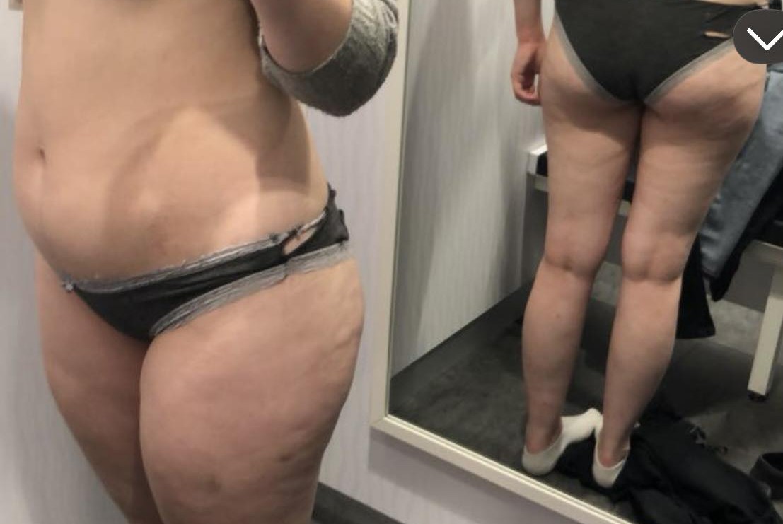 Cellulite an den Oberschenkeln