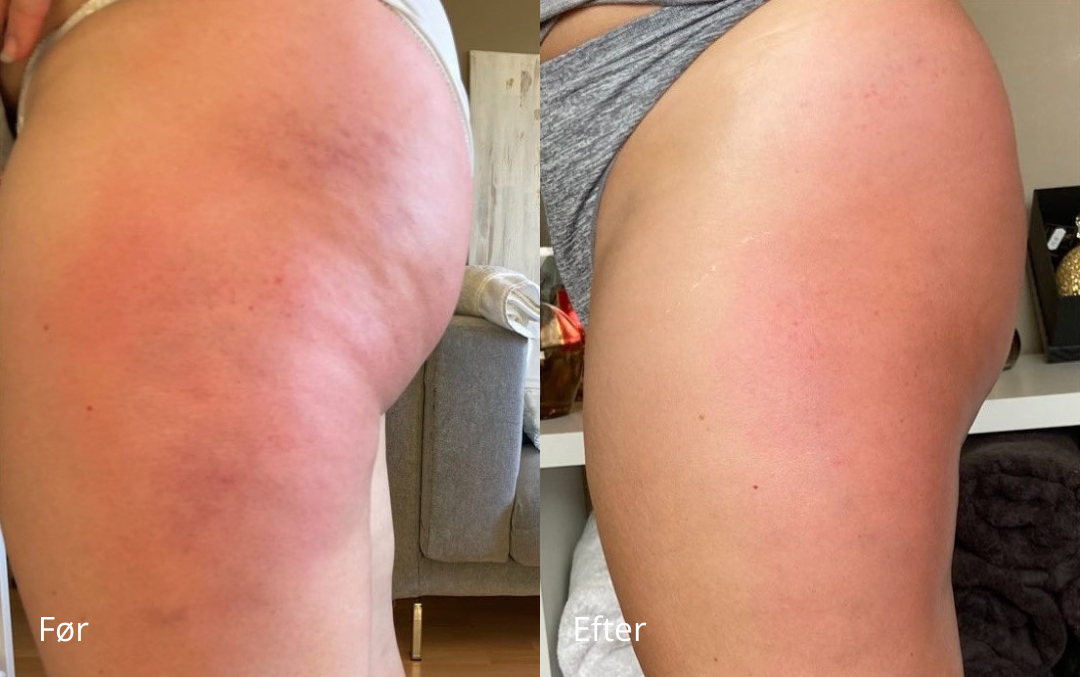 Side-by-side comparison showing skin appearance before and after treatment.