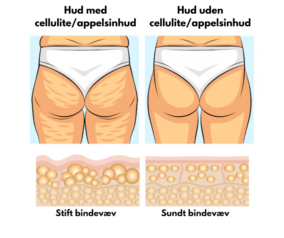 Illustration comparing cellulite with smooth skin and connective tissue structures.