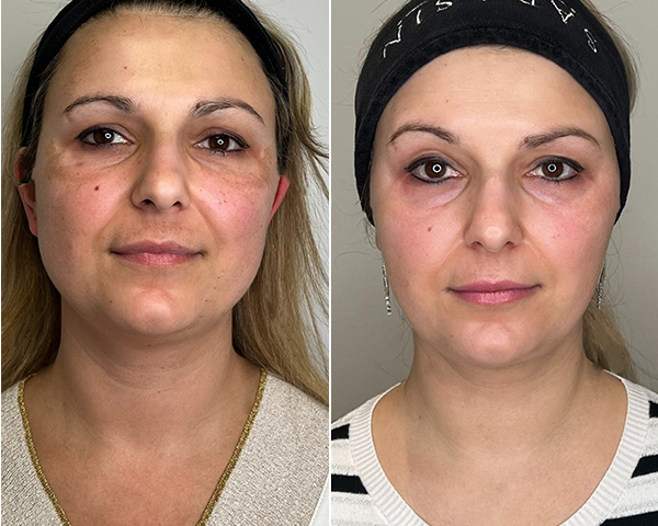 Side-by-side comparison of a woman's face before and after treatment.