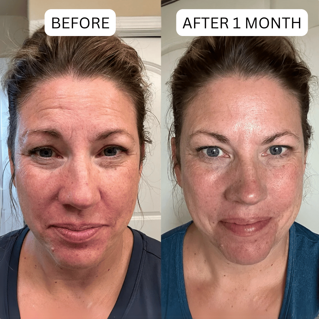 Side-by-side comparison of a woman's face before and after one month.