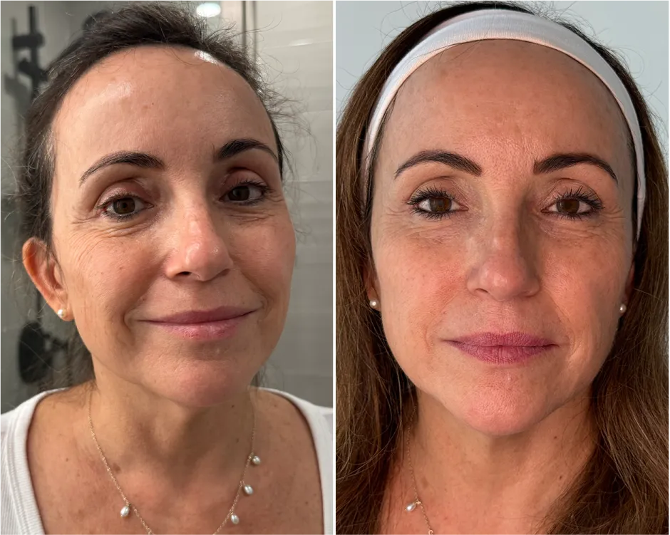 Side-by-side comparison of a woman's face before and after treatment.