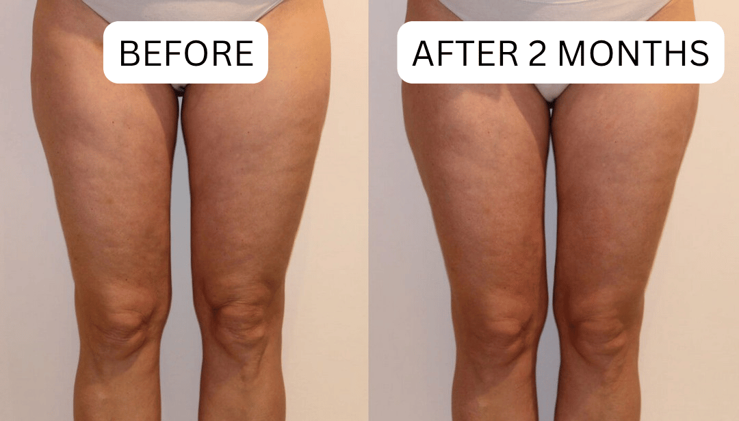 Comparison of thighs before and after two months.