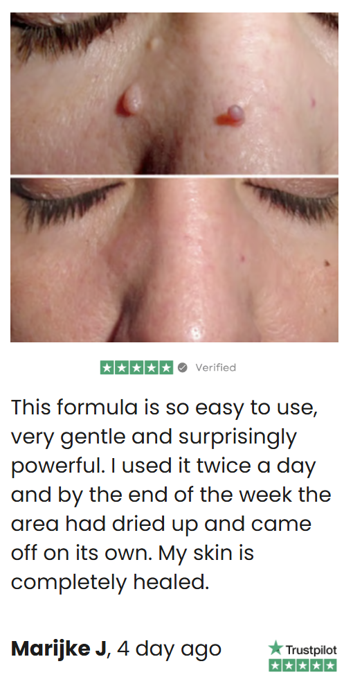 A before-and-after image showing the removal of two skin tags from the bridge of a person's nose.