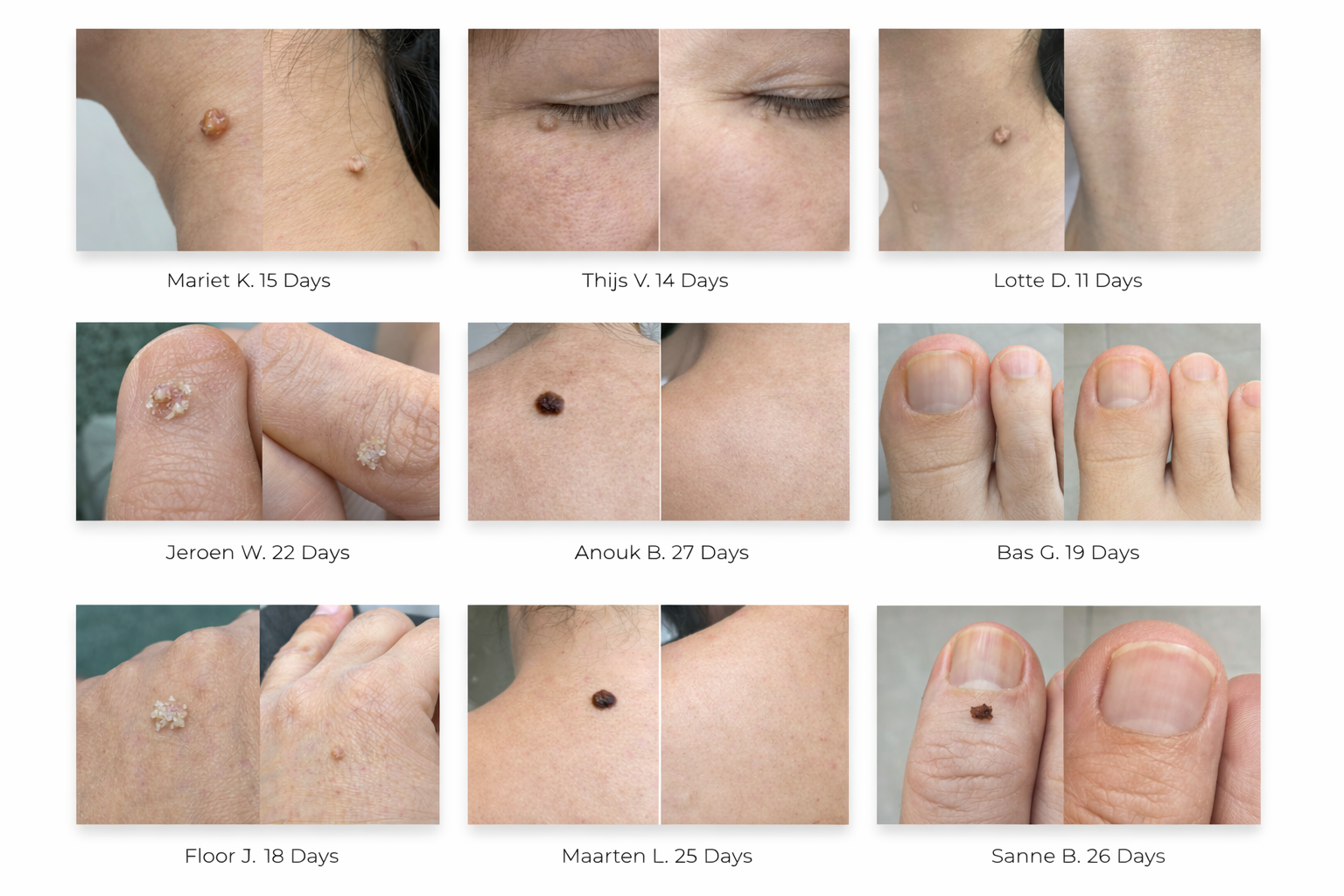 A collage of nine before-and-after photos showing the removal of skin blemishes like moles and warts.