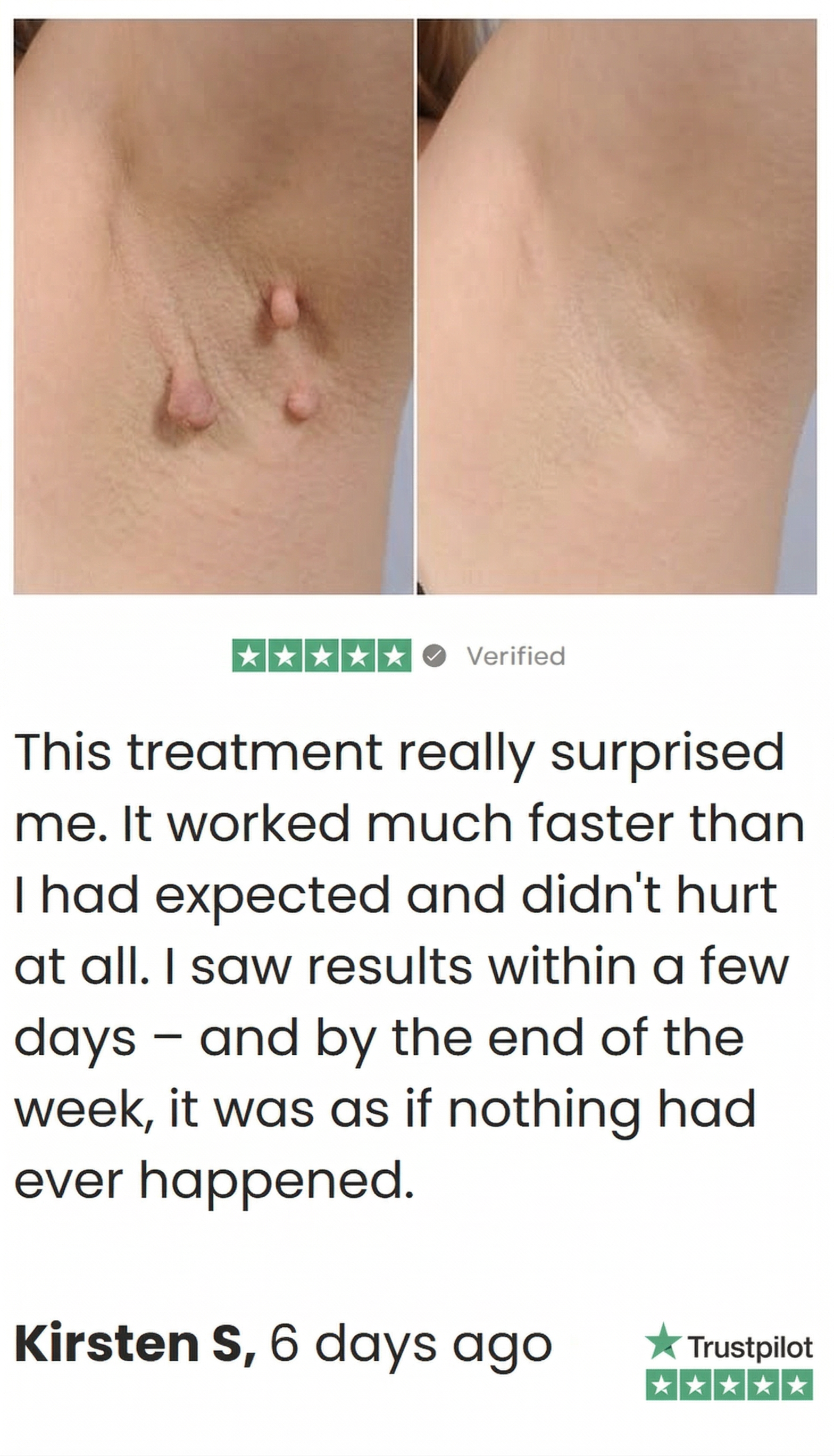 Before and after photos of a woman's face, showing mole removal, above a customer testimonial from Kirsten S.