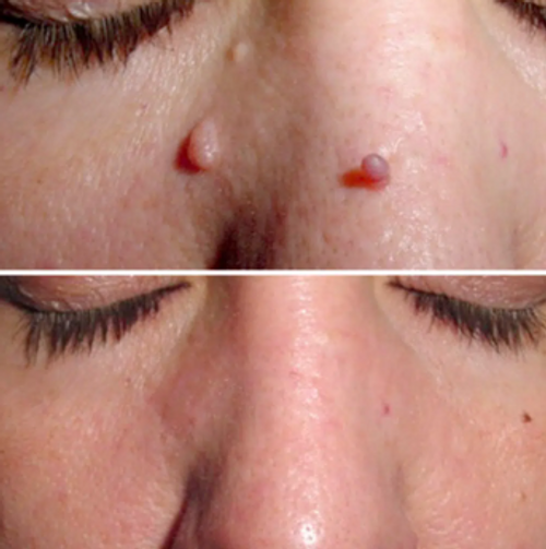 Close-up of a face before and after mole removal.