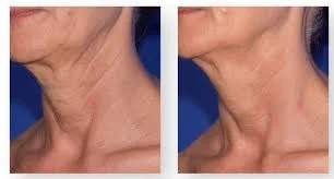 Before and after photos of a person's neck, showing a visible reduction in wrinkles and smoother skin.