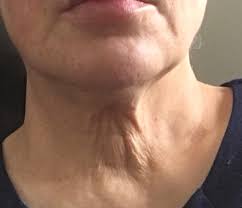 A close-up of a person's lower face and neck, showing wrinkled skin.