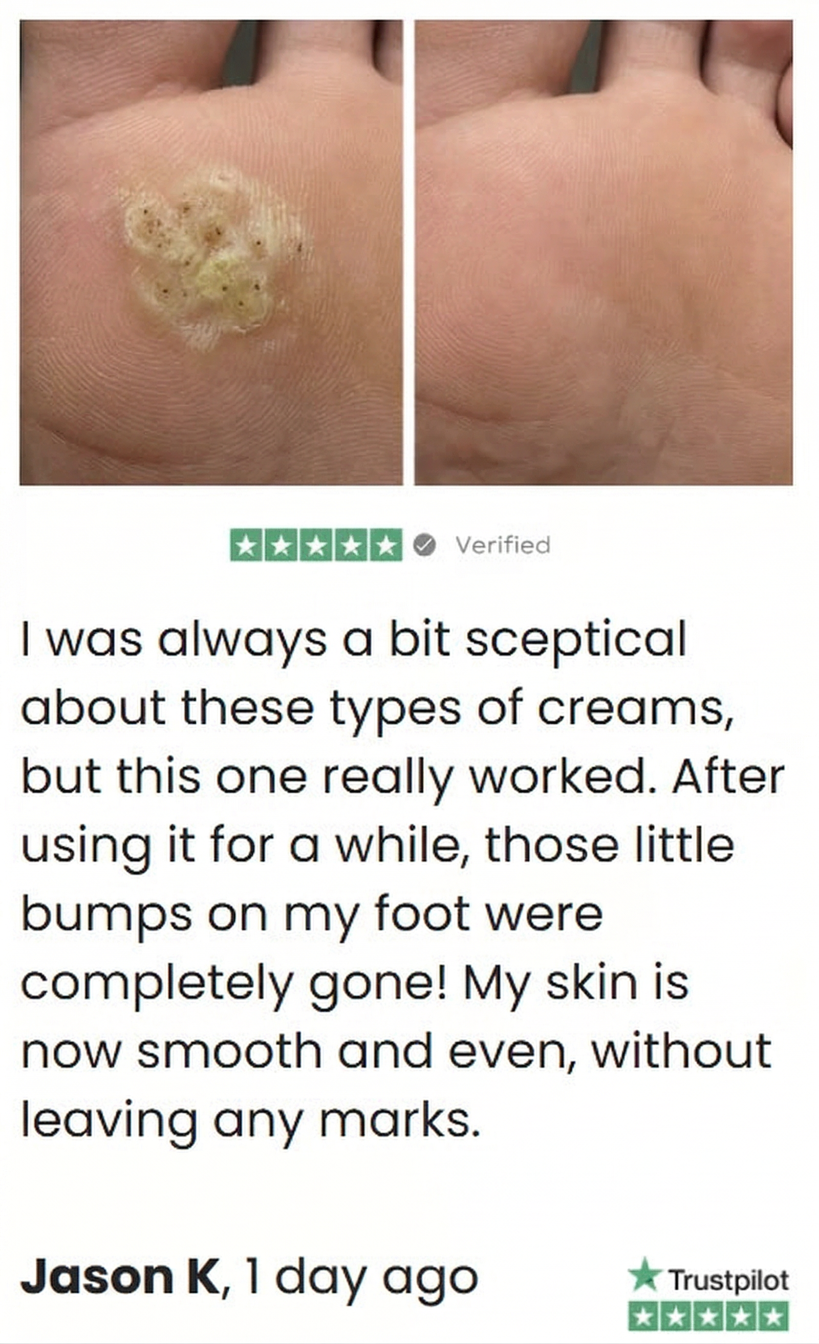Before and after photos showing the removal of bumps and skin tags from a person's neck.