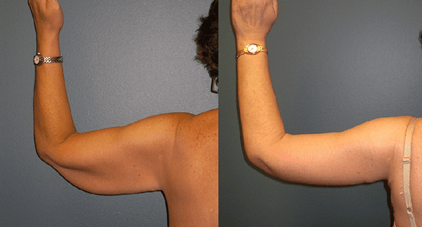 A side-by-side comparison of a woman's upper arm from the back, showing a before and after view.