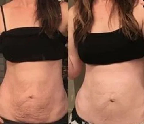 A before-and-after image showing a woman's midsection, with a visible change in skin texture and stretch marks.