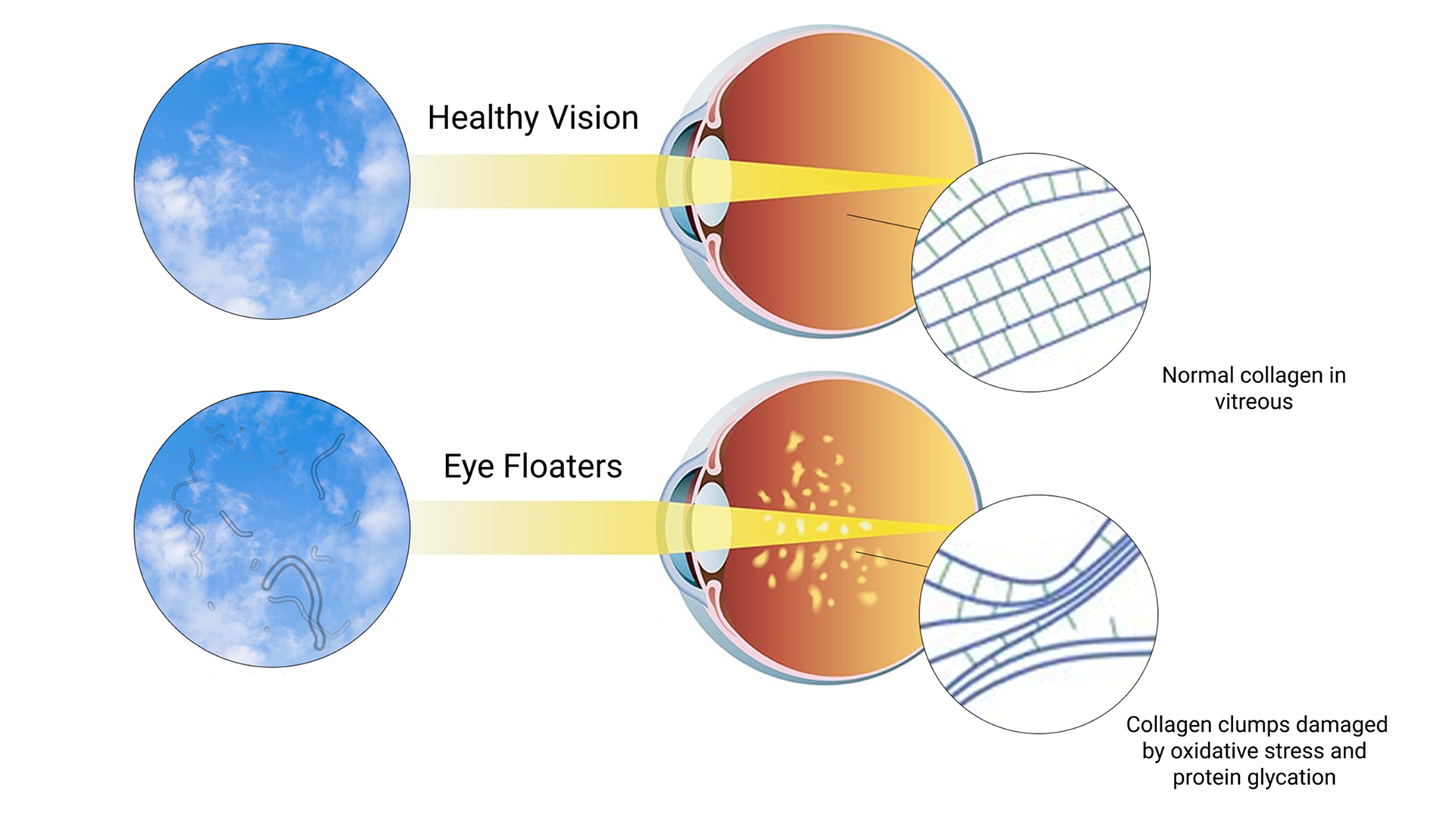 Diagram comparing healthy vision and eye floaters with collagen structure.